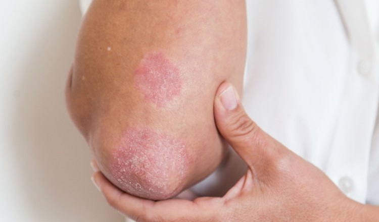 Las personas que padecen psoriasis presentan lesiones escamosas en la piel. Foto Ilustrativa