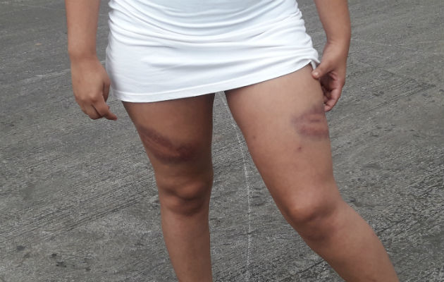 Fue golpeada muy fuerte en ambas piernas por policías en Chiriquí. 