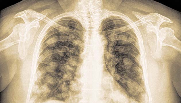 El cáncer de pulmón es uno de los más comunes.