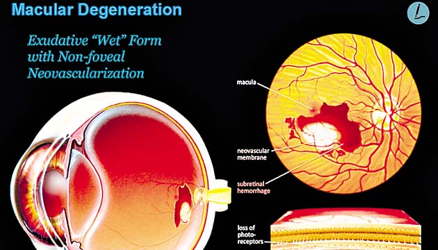 La degeneración macular daña los vasos sanguíneos que irrigan la mácula.