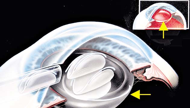 Con ‘lente intraocular multifocal’ no es necesario utilizar anteojos.