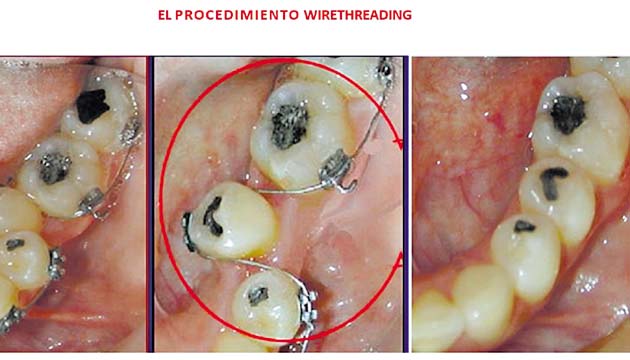 Con el procedimiento ‘wirethrearding’ el paciente observará el alineamiento de los dientes.(Cortesía)