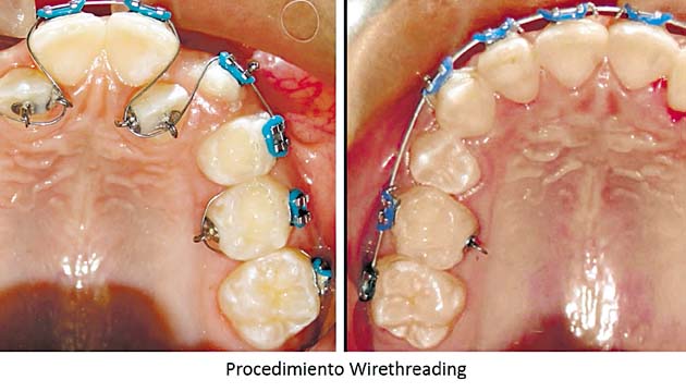 Así funciona la técnica de tejer con alambres los dientes.