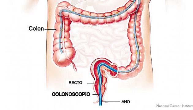 Solo se debe realizar limpieza por una colonoscopia, según especialistas.