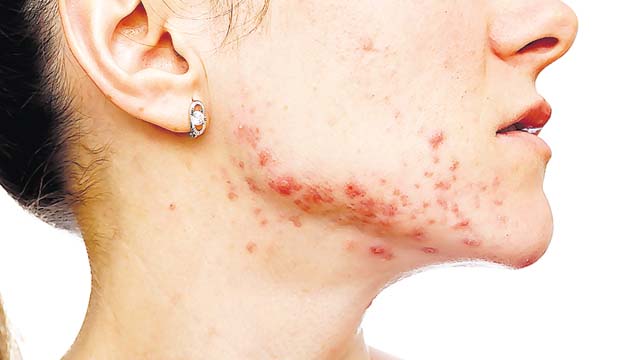 El acné puede ser otra de las consecuencias de maquillaje vencido.
