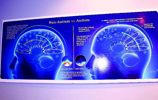 Comparación de un cerebro con autismo y sin la condición. Neuropatologías... ¿y ahora qué hago?