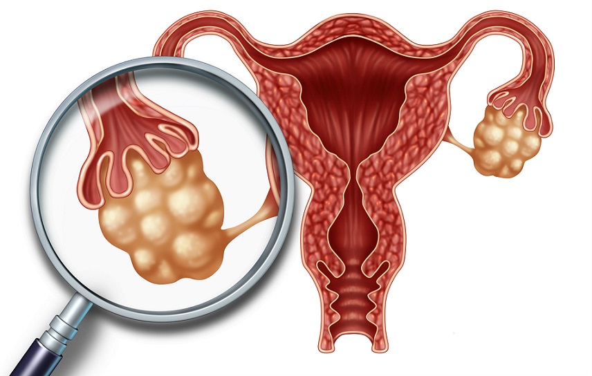 El cáncer de ovario es el séptimo más padecido entre las mujeres en el mundo.