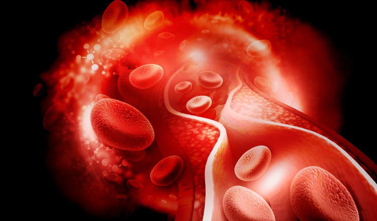 La trombosis venosa profunda (TVP) y la embolia pulmonar (EP).  