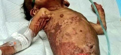 Muere lactante que estaba recluido por desnutrición en hospital de David El menor murió por una falla a multiorgánica por las infecciones severas que tenia en la piel. Foto: Mayra Madrid.