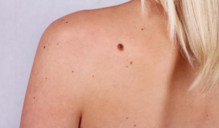 Lo que dispara una mayor probabilidad de padecer melanoma es la exposición crónica al sol.  Pixabay