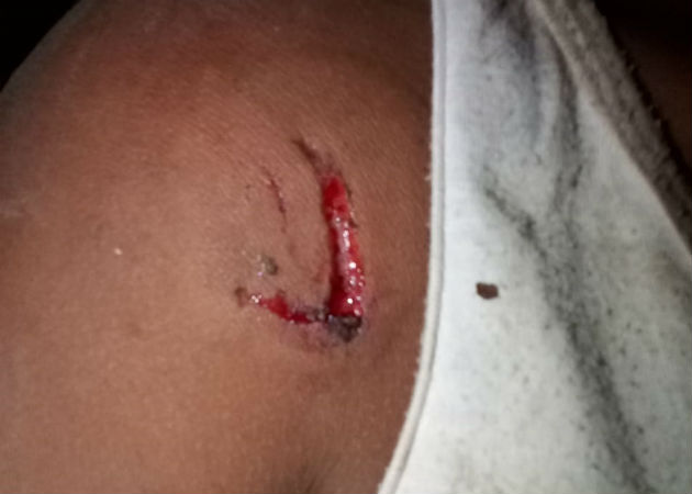 La menor fue mordida por su primo en el hombro y mano derecha. Fotos: Mayra Madrid.