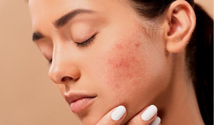 La dermatitis atópica es una deficiencia en la barrera de la piel. Pixabay