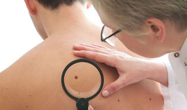 Las tasas de melanoma han aumentado rápidamente en las últimas décadas. Foto: Ilustrativa / Pixabay