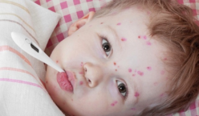 En los niños con un sistema inmunitario normal, la varicela no suele ser grave.  Foto: Ilustrativa /Pixabay