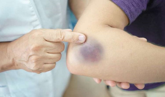 Puede ocasionar hematomas.  Foto: Pixabay / Ilustrativa