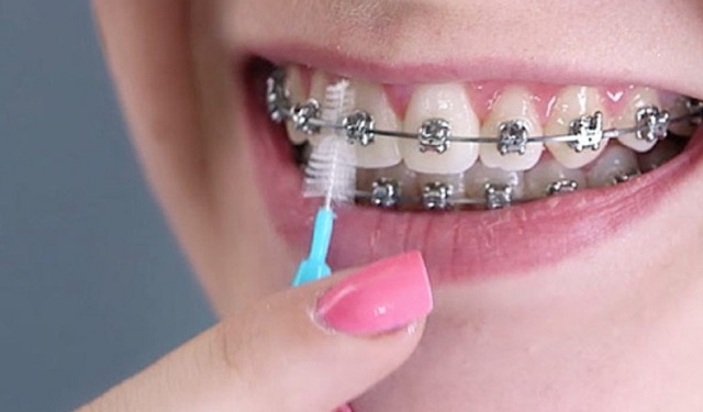 Los 'brackets' son pegados con resina de alta resistencia. Foto:  Ilustrativa / Pixabay