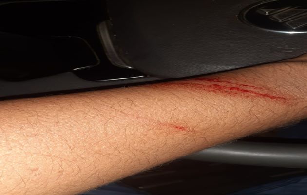 El conductor del vehículo recolector forcejeó,  con su atacante recibiendo una herida en uno de sus brazos y la pierna. Foto: Diomedes Sánchez