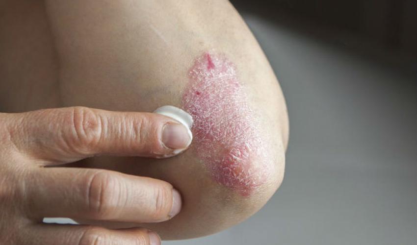 Corresponderá al Ministerio de Salud establecer un sistema de información que mantenga actualizada la lista de personas con psoriasis. Foto: Archivos