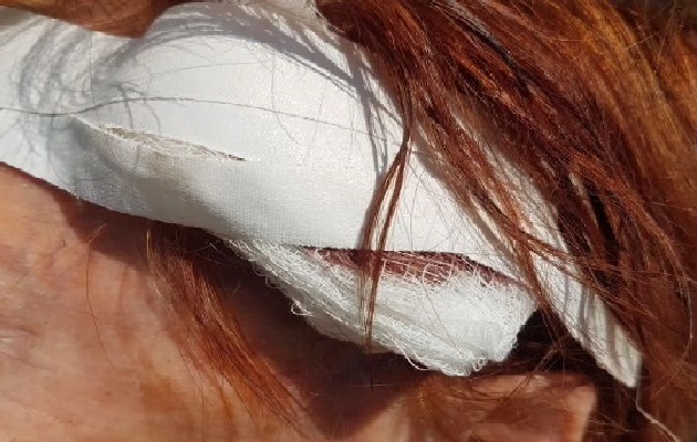 A través de las redes sociales se mostró la herida sufrida en la cabeza por la adulta mayor, y por la cual requirió de suturas en el hospital Nicolás A. Solano, además de otros exámenes médicos.