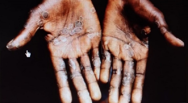 La viruela símica causa lesiones cutáneas en manos, plantas de los pies o cara. Foto: Archivo Ilustrativa 