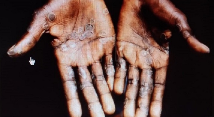 La viruela símica causa lesiones cutáneas en manos, plantas de los pies o cara. Foto: Archivo Ilustrativa