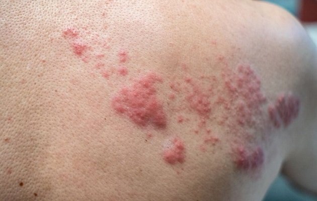 La neuralgia post-herpética es la patología desencadenante más frecuente del herpes zóster.