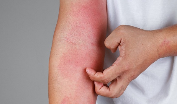 La dermatitis atópica afecta al menos a 230 millones de personas en todo el mundo. Foto: Pexels