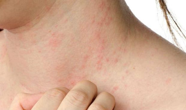 Stress, its influence on atopic dermatitis