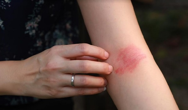Atopic dermatitis in adults Atopic dermatitis in adults