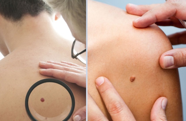 Un lunar inusual podría ser señal de melanoma. Foto: Pexels