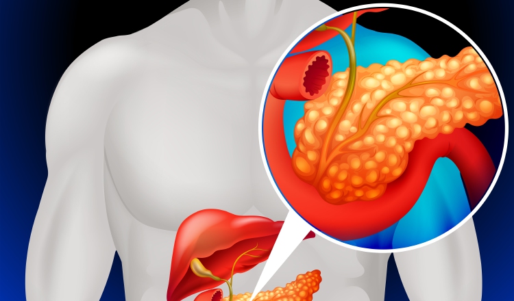 Las personas con obesidad y diabetes tipo 2 tienen más riesgo de padecer cáncer de páncreas.  Ilustrativa / Freepik