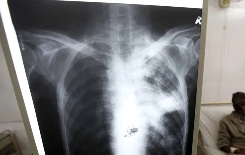 La tuberculosis puede ser mortal si no se trata. Foto: EFE