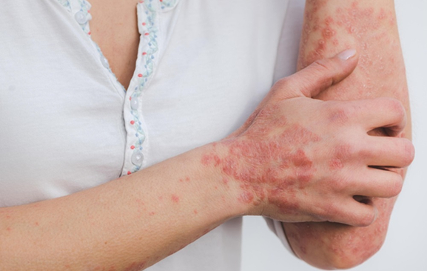 Lesiones cutáneas características de la psoriasis. Foto: Eszter Miller / Pixabay Lesiones cutáneas características de la psoriasis. Foto: Eszter Miller / Pixabay