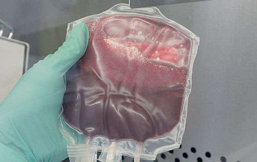 <p> Verifique las transfusiones.</p>