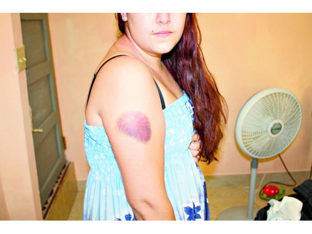 Huellas en el brazo de Flores, como consecuencia de la agresión.(Cortesía)