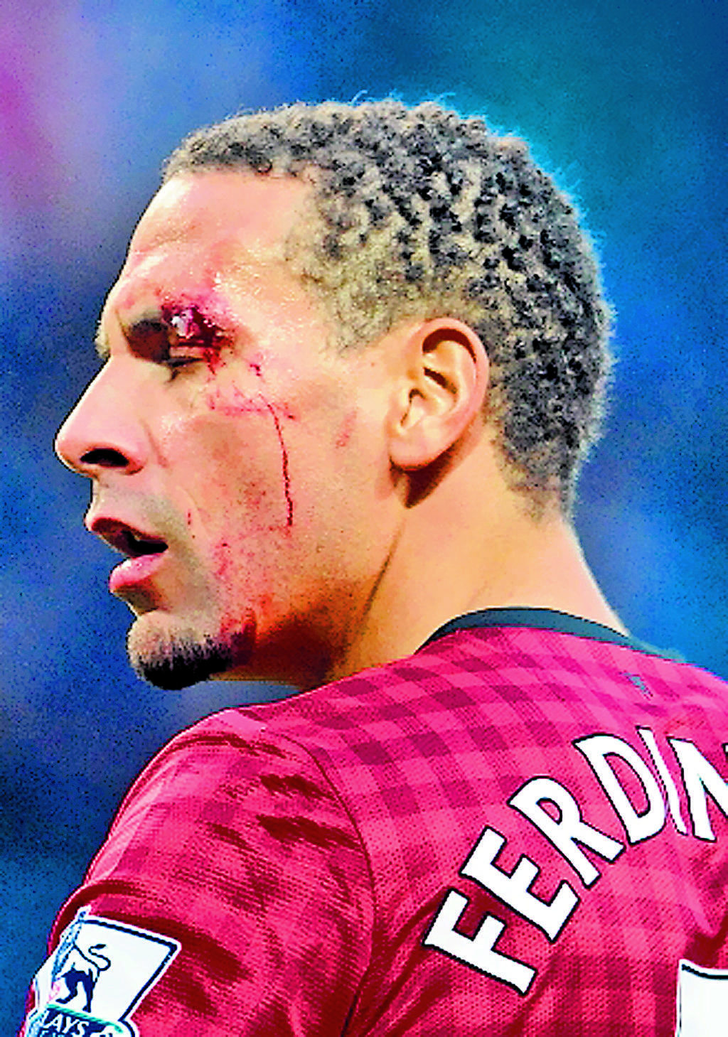 La herida de Ferdinand(AP)