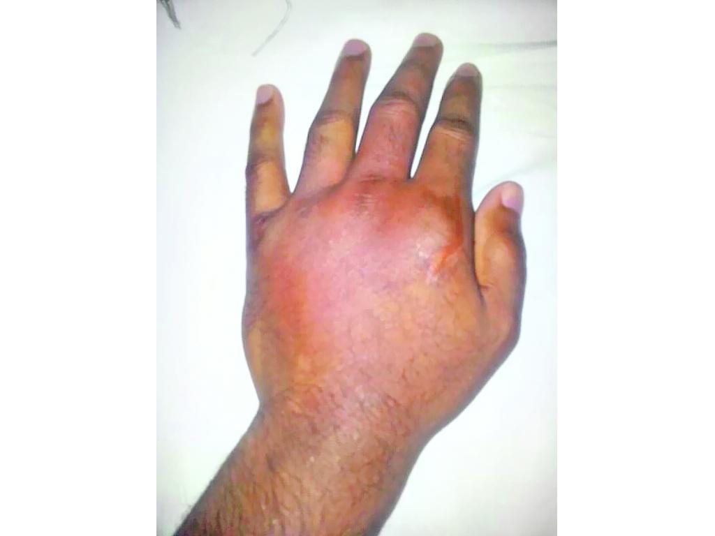 Mano izquierda de Vásquez(Cortesía)