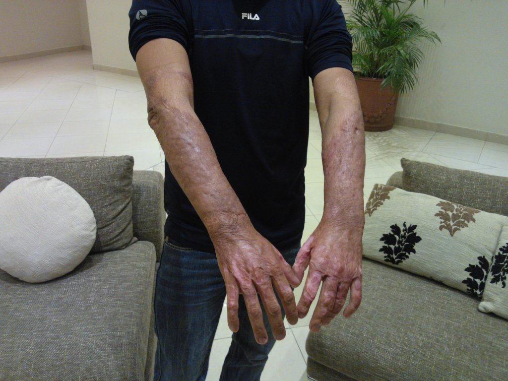David Velásquez, sobreviviente de la explosión que se produjo en el edificio PH White de la Avenida Balboa. Foto/Luis R. Ábrego<br>