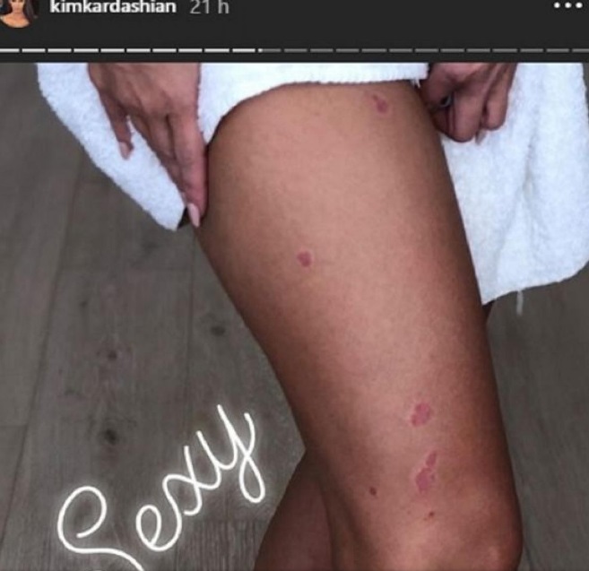 Kim Kardashian muestra sus lesiones de la psoriasis. Foto: Instagram