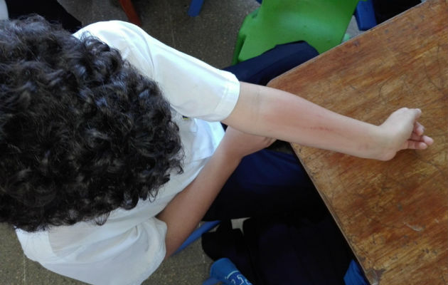Los estudiantes del centro educativo en La Chorrera, en Panamá Oeste, presentan reacciones alérgicas en la piel. 
