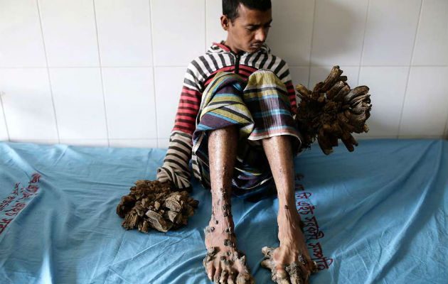  Abul Bajandar tiene 26 años. Foto/ EFE