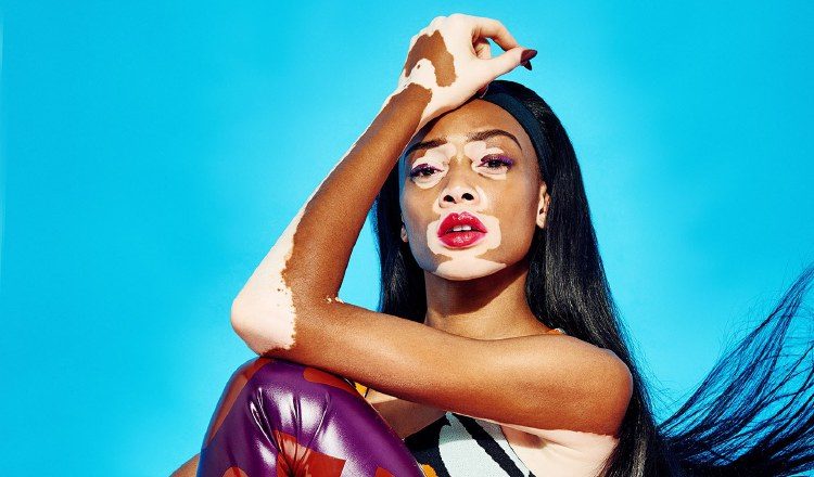 Winnie Harlow