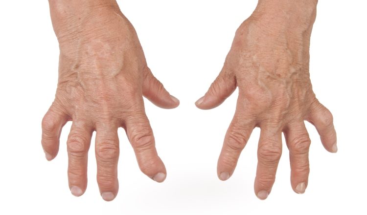 Al padecer esta enfermedad se debe evitar el lavado excesivo de las manos.