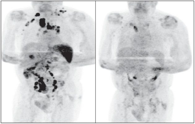 La remisión parcial del linfoma de Hodgkin se produjo tras la infección.