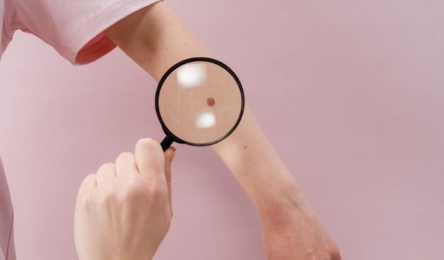 Anualmente se debe visitar al dermatólogo para una revisión completa de la piel. Foto: Ilustrativa / Pexels
