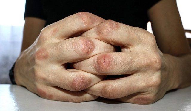 Se trata de una enfermedad crónica.  Foto: Ilustrativa / Pixabay