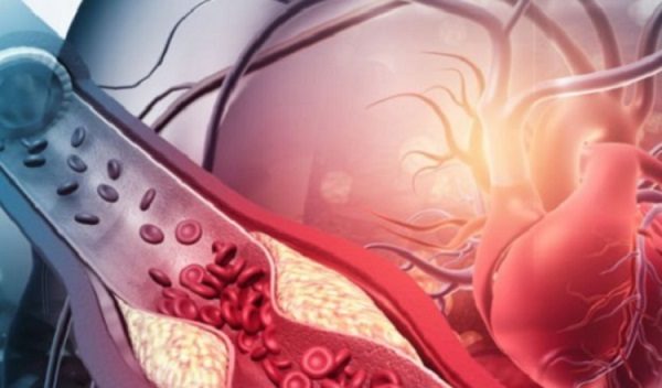 Llevar una vida más saludable permite tener arterias más sanas. Foto: www.istockphoto.com