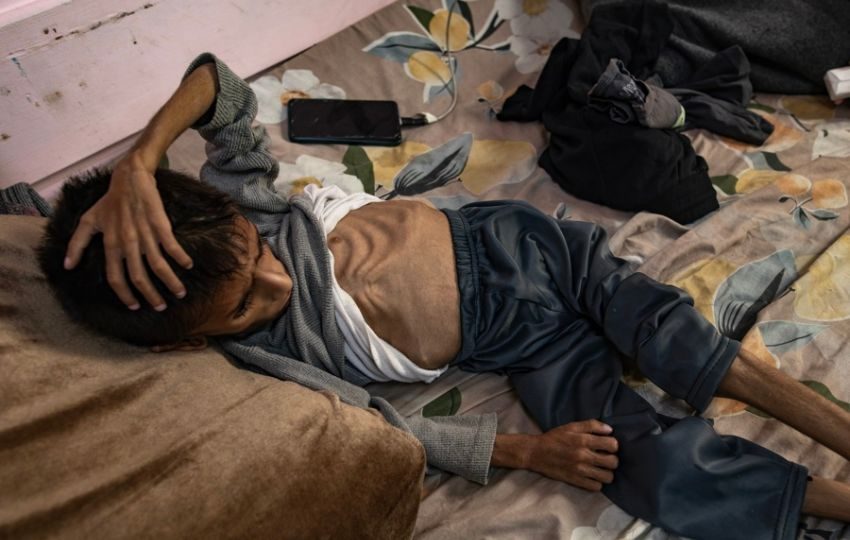 El niño palestino de cinco años Osama al-Raqab sufre de desnutrición severa. Foto: EFE