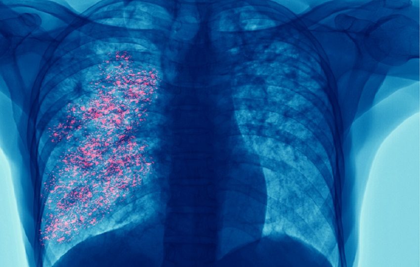 El diagnóstico tardío incrementa la carga para los pacientes, sus familias y los sistemas de salud. Cortesía/•	El diagnóstico tardío incrementa la carga para los pacientes, sus familias y los sistemas de salud. Foto: AstraZeneca