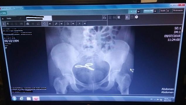 Tras la mala praxis la mujer sufrió una trombosis venosa profunda que casi termina con un paro cardiorespiratorio. Foto: redes sociales.